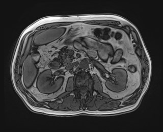 Cecal mass causing appendicitis (Radiopaedia 59207-66532 D 56).jpg