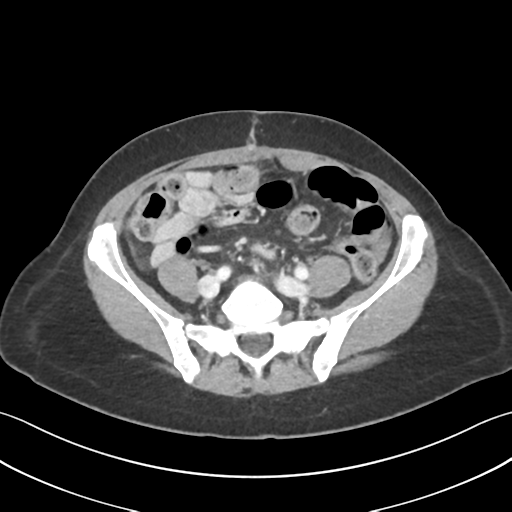 Cecum hernia through the foramen of Winslow (Radiopaedia 46634-51112 A 49).png