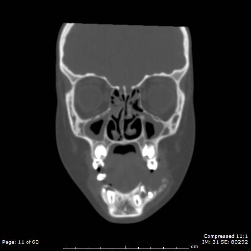 Central giant cell granuloma (Radiopaedia 45612-49754 Coronal bone window 11).jpg
