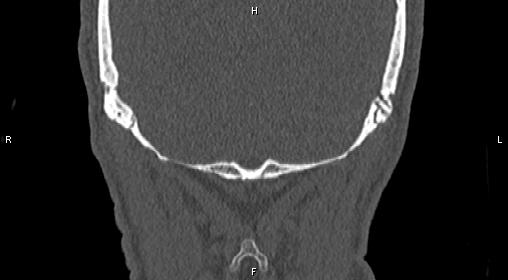 Central giant cell granuloma (Radiopaedia 83346-97761 Coronal bone window 46).jpg