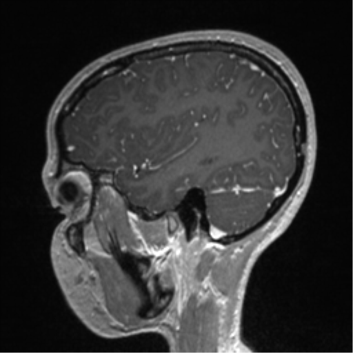 File:Central neurocytoma (Radiopaedia 37664-39557 Sagittal T1 C+ 73).png