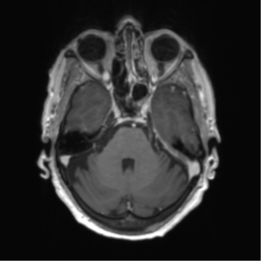 Central neurocytoma (Radiopaedia 65317-74345 Axial T1 C+ 11).png