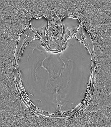 Central neurocytoma (Radiopaedia 84497-99872 Axial 27).jpg