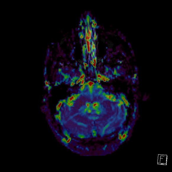 Central neurocytoma (Radiopaedia 84497-99872 Axial Perfusion 259).jpg