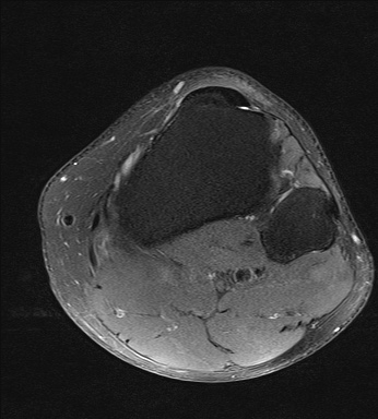 File:Central osteophyte (Radiopaedia 72592-83150 Axial PD fat sat 33).jpg