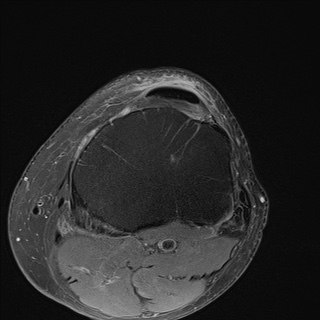 File:Central osteophyte (Radiopaedia 72592-83151 Axial PD fat sat 27).jpg