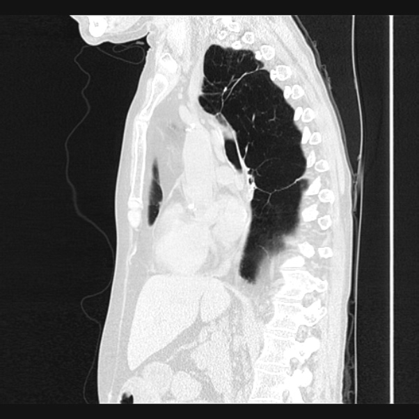 Centrilobular pulmonary emphysema (Radiopaedia 24495-24789 Sagittal lung window 39).jpg