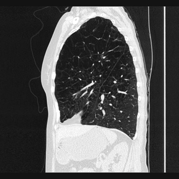 Centrilobular pulmonary emphysema (Radiopaedia 24495-24789 Sagittal lung window 60).jpg