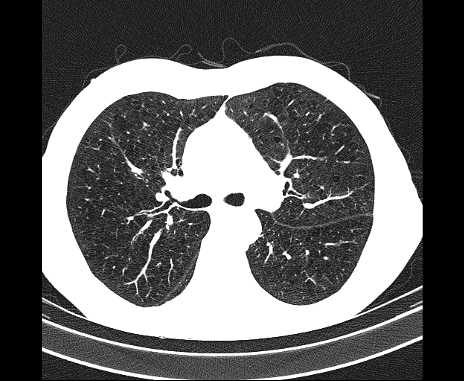 Centrilobular pulmonary emphysema (Radiopaedia 62468-70718 Axial lung window 31).jpg