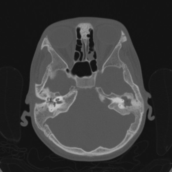File:Cerebellar abscess secondary to mastoiditis (Radiopaedia 26284-26413 Axial bone window 56).jpg