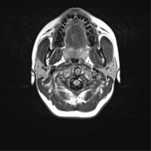 File:Cerebellar agenesis with hypoplastic pons (pontocerebellar hypoplasia) (Radiopaedia 57224-64138 Axial FLAIR 1).png