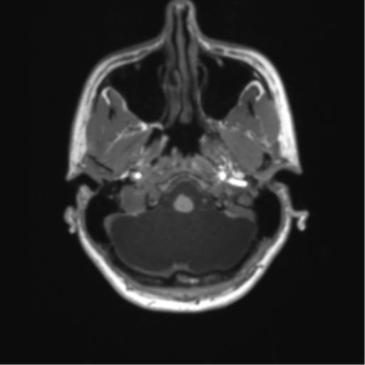 Cerebellar agenesis with hypoplastic pons (pontocerebellar hypoplasia) (Radiopaedia 57224-64138 Axial T1 15).png