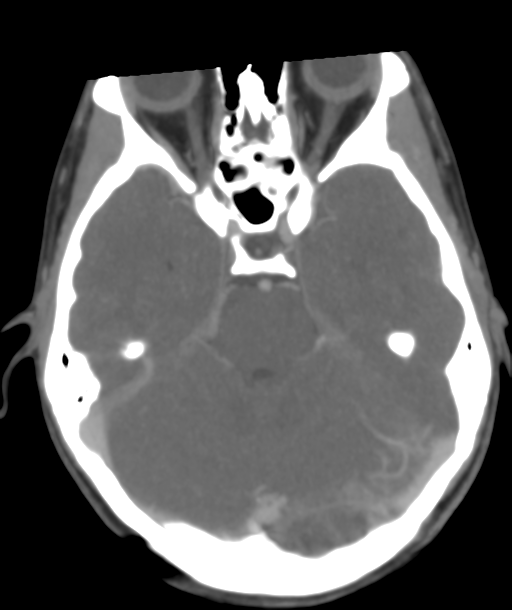 Cerebellar arteriovenous malformation- with hemorrhage (Radiopaedia 35752-37297 B 18).png