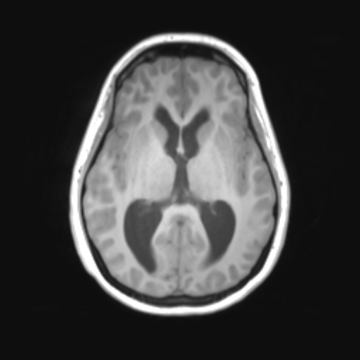 File:Cerebellar ependymoma complicated by post-operative subdural hematoma (Radiopaedia 83322-97736 Axial T1 22).png