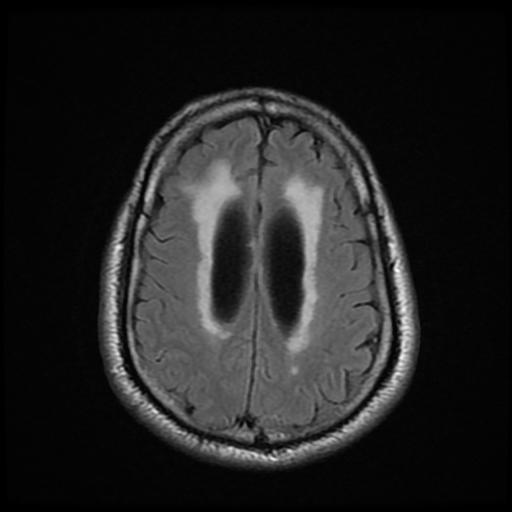 File:Cerebellar hemangioblastoma (Radiopaedia 88055-104622 Axial FLAIR 19).jpg