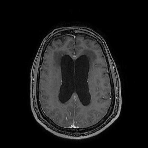 Cerebellar hemangioblastoma (Radiopaedia 88055-104622 Axial T1 C+ 115).jpg