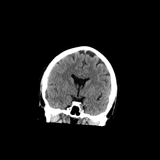 File:Cerebellar infarct due to vertebral artery dissection with posterior fossa decompression (Radiopaedia 82779-97031 Axial non-contrast 1).png