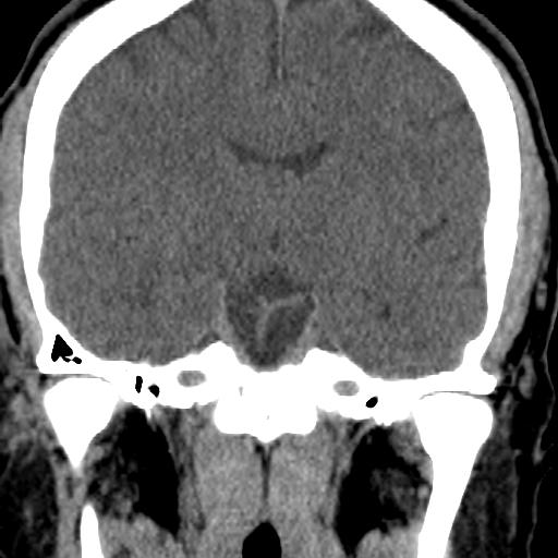 Cerebellar infarction (Radiopaedia 16625-16327 Coronal non-contrast 7).jpg