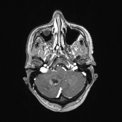 File:Cerebellar metastases (Radiopaedia 24038-24249 Axial T1 C+ 46).jpg