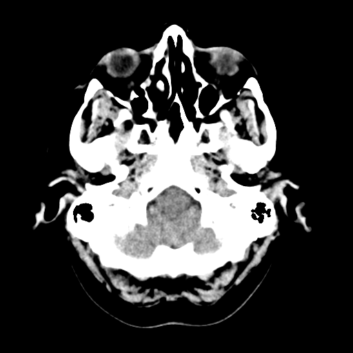 Cerebellar metastasis (Radiopaedia 54578-60812 Axial non-contrast 7).png