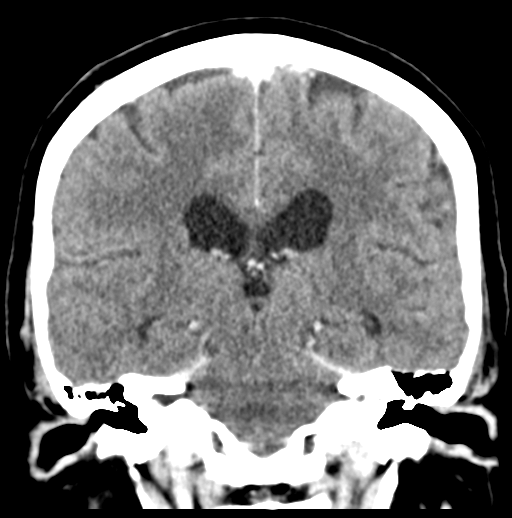 Cerebellar metastasis (Radiopaedia 54578-60812 Coronal C+ 34).png