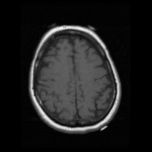 File:Cerebellar metastasis (cystic appearance) (Radiopaedia 41395-44262 Axial T1 17).png