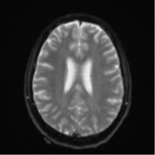 Cerebellar metastasis - adenocarcinoma lung (Radiopaedia 63184-71715 Axial DWI 20).png