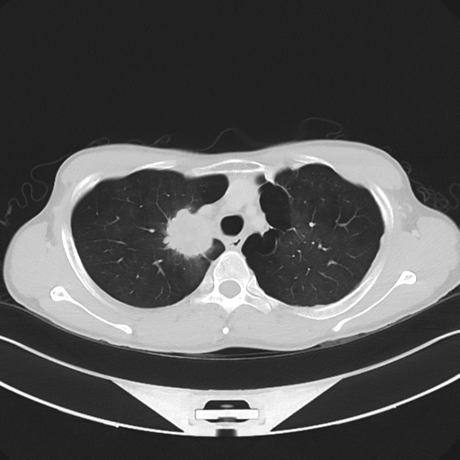 Cerebellar metastasis - adenocarcinoma lung (Radiopaedia 63184-71717 Axial lung window 19).png