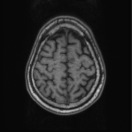 Cerebellar metastasis from lung adenocarcinoma (Radiopaedia 86690-102829 Axial T1 67).png