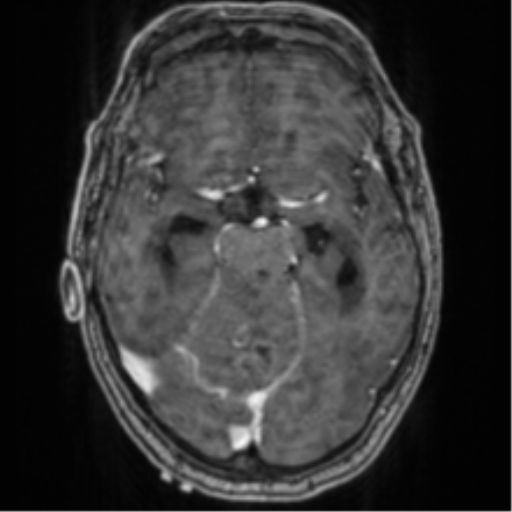 Cerebellar metastasis from lung adenocarcinoma (Radiopaedia 86690-102829 Axial T1 C+ 33).png