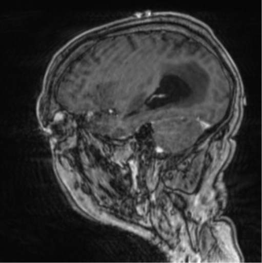 Cerebellar metastasis from lung adenocarcinoma (Radiopaedia 86690-102829 Sagittal T1 C+ 23).png