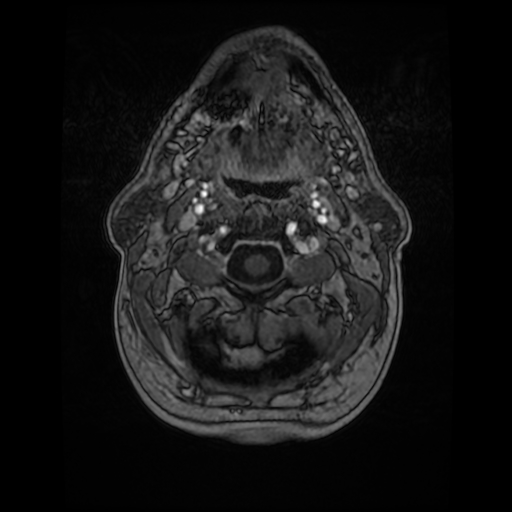 Cerebellar metastasis of pulmonary adenocarcinoma, cavernous venous malformation, and developmental venous anomaly (Radiopaedia 85827-101661 Axial T1 C+ 8).jpg