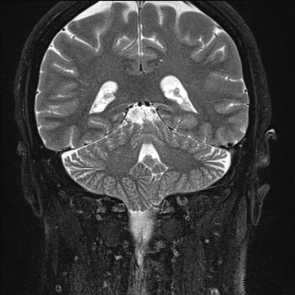 File:Cerebellopontine angle meningioma (Radiopaedia 53561-59591 Coronal T2 20).jpg