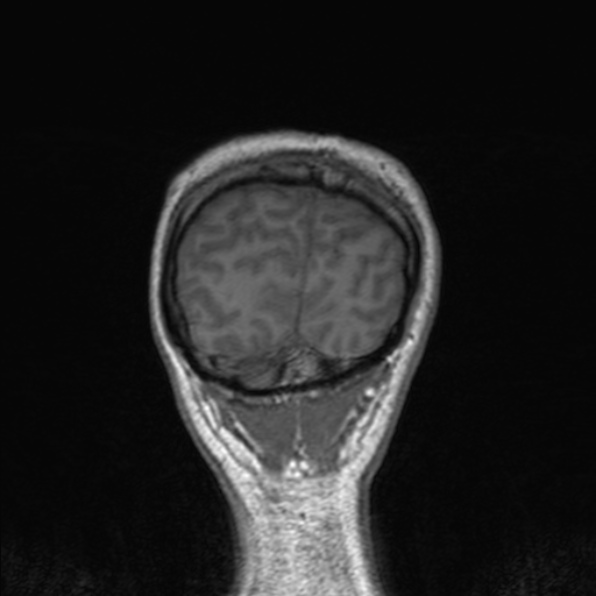 Cerebral abscess (Radiopaedia 24212-24478 Coronal T1 178).jpg