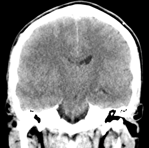 Cerebral abscess (Radiopaedia 60342-68008 Coronal non-contrast 34).png
