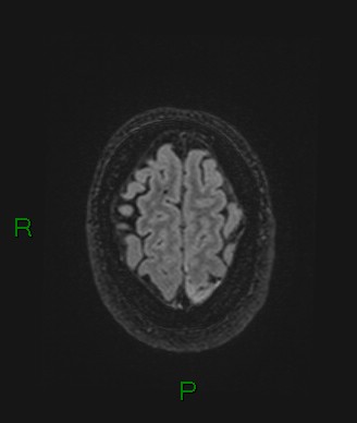 Cerebral abscess and subdural empyema (Radiopaedia 84436-99779 Axial FLAIR 16).jpg