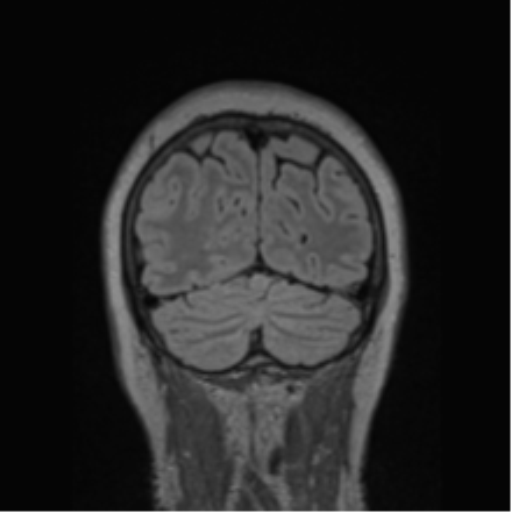 Cerebral abscess from pulmonary arteriovenous malformation (Radiopaedia 86275-102291 Coronal FLAIR 20).png