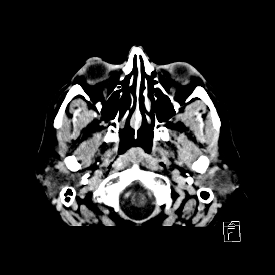 File:Cerebral abscess with ventriculitis (Radiopaedia 78965-91877 A 4).jpg