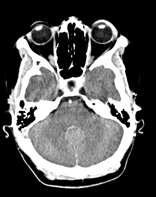 Cerebral abscesses (Radiopaedia 70458-80568 Axial Contrast 19).jpg