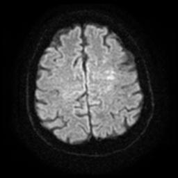 Cerebral amyloid angiopathy (Radiopaedia 28698-28978 Axial DWI 22).jpg