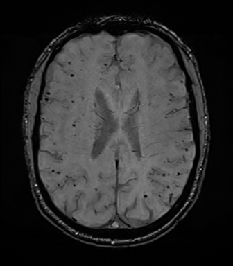 File:Cerebral amyloid angiopathy (Radiopaedia 46082-50433 Axial SWI 52).png