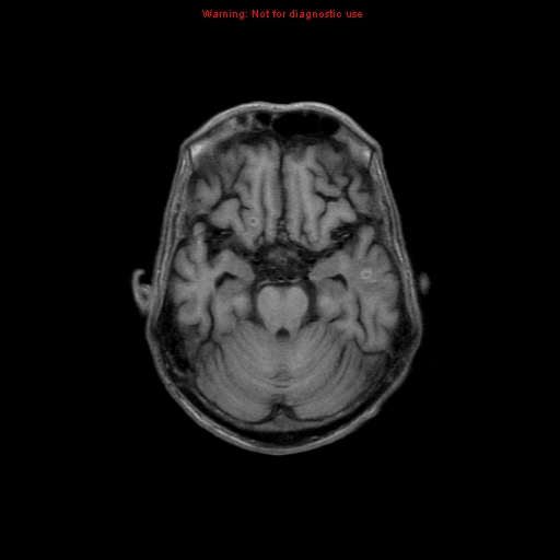 File:Cerebral and orbital tuberculomas (Radiopaedia 13308-13311 Axial T1 8).jpg