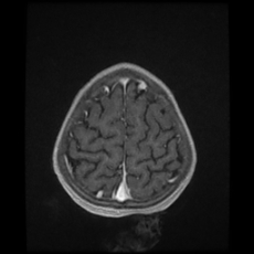 File:Cerebral and spinal tuberculosis (Radiopaedia 90489-107837 Axial T1 C+ 166).jpg