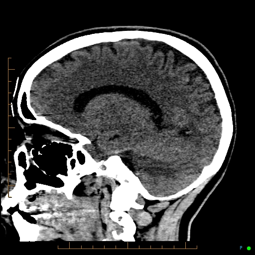 Cerebral arteriovenous malformation (AVM) (Radiopaedia 78162-90706 A 48).jpg