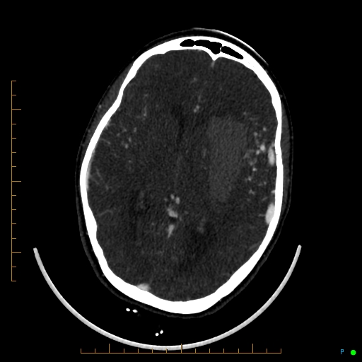 Cerebral arteriovenous malformation (AVM) (Radiopaedia 78162-90706 Axial CTA 144).jpg