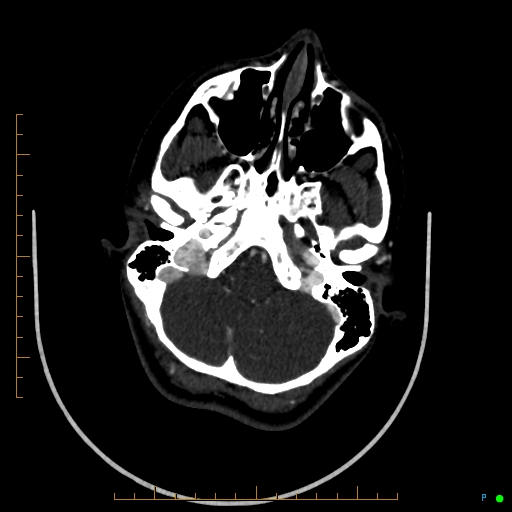 Cerebral arteriovenous malformation (AVM) (Radiopaedia 78162-90706 Axial CTA 66).jpg