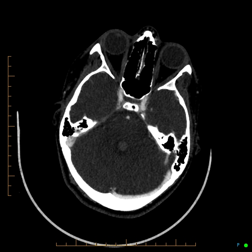 Cerebral arteriovenous malformation (AVM) (Radiopaedia 78162-90706 Axial CTA 95).jpg