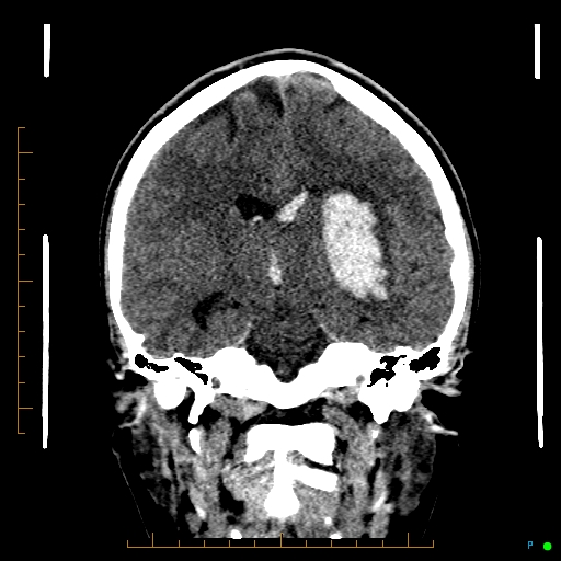 File:Cerebral arteriovenous malformation (AVM) (Radiopaedia 78162-90706 Coronal non-contrast 52).jpg