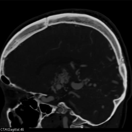 File:Cerebral arteriovenous malformation (Radiopaedia 28518-28759 D 43).jpg