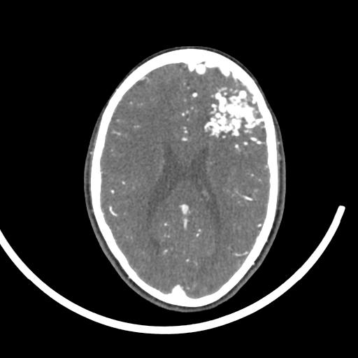 Cerebral arteriovenous malformation (Radiopaedia 29531-30031 E 50).jpg